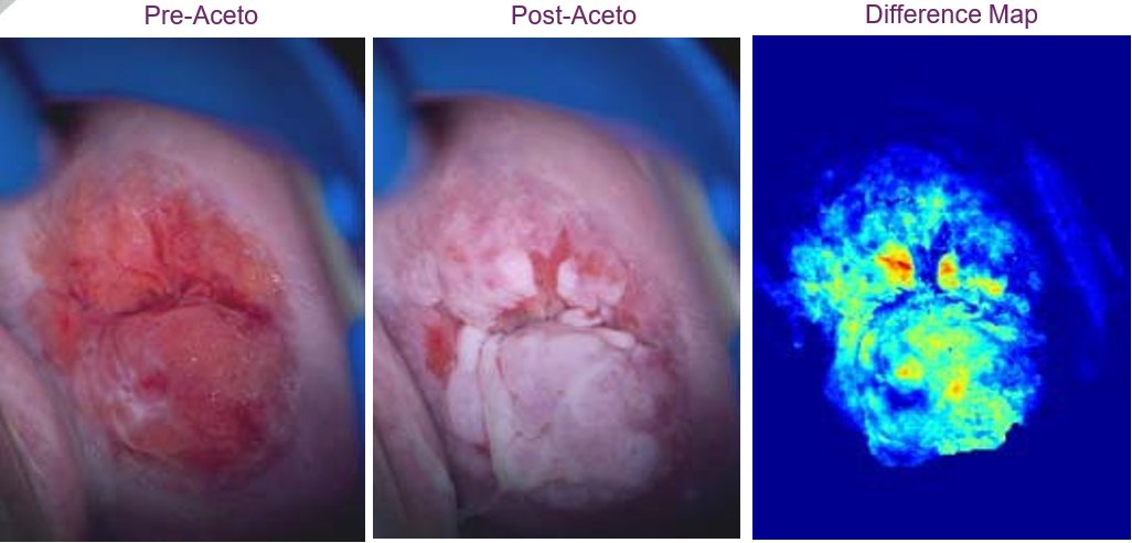 Acetowhite lesion detection: Pre-Aceto, Post-Aceto, and Difference Map panels showing acetowhite change mapping